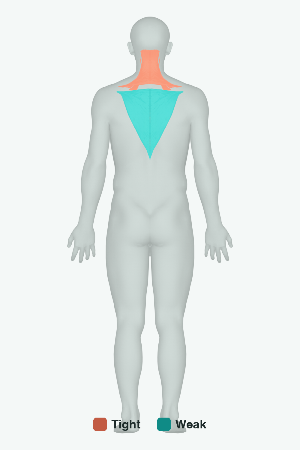 Muscles involved in Forward Head Posture, back view — typically tight muscles in coral, typically weak in teal